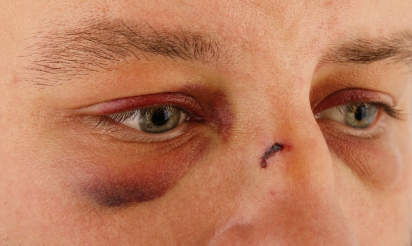 domestic-violence-male_black-eyes_molodec-shutterstock